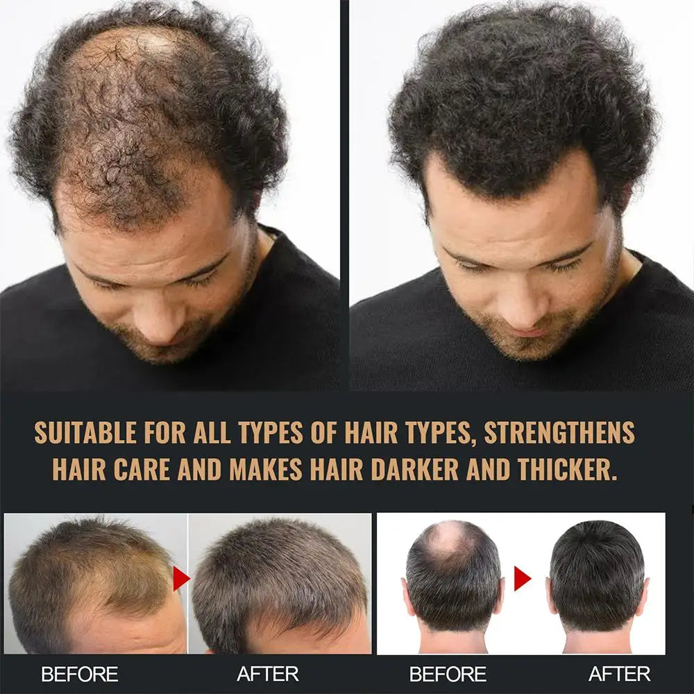 2PCS Anti Baldness Shampoo Thickening Shampoo Root Activator Shampoo Nourish Hair Regrowth Shampoo For Thinning Hair & Hair Loss