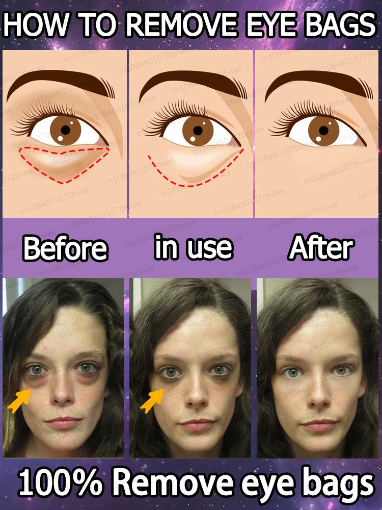 The heavier the eye bags and dark circles, the better the effect