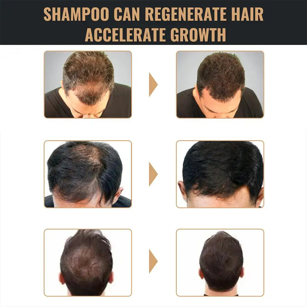 2PCS Anti Baldness Shampoo Thickening Shampoo Root Activator Shampoo Nourish Hair Regrowth Shampoo For Thinning Hair & Hair Loss